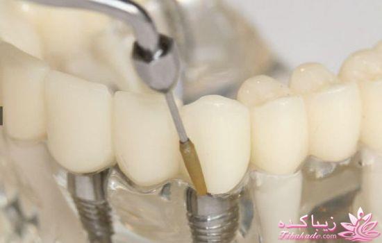 جرم گیری ایمپلنت